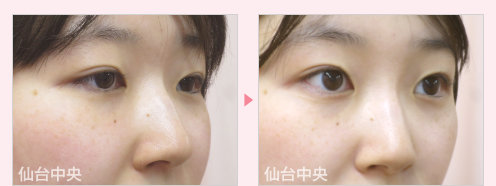 鼻ヒアルロン酸注入 症例写真2