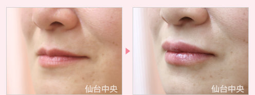 唇を厚く 症例写真3