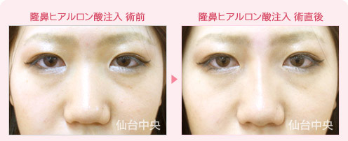 隆鼻ヒアルロン酸注入 症例写真1