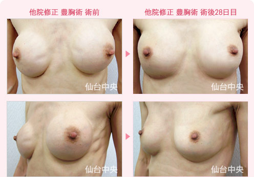 他院修正 豊胸術
