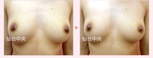 他院修正陥没乳頭右 症例写真1