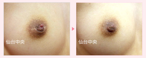 他院修正陥没乳頭右 症例写真3