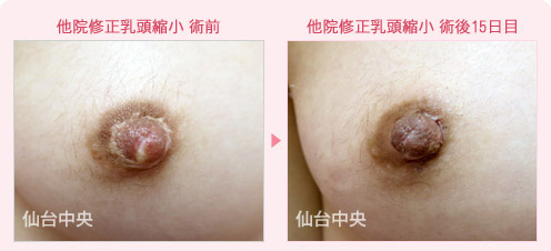 他院修正乳頭縮小 症例写真1