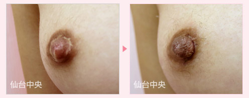 他院修正乳頭縮小 症例写真2