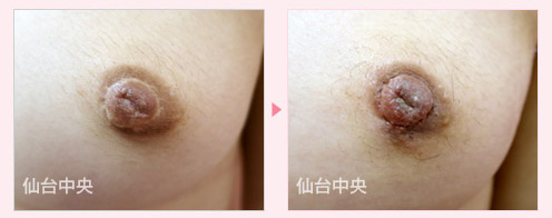 他院修正乳頭縮小 症例写真3