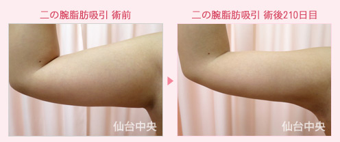 二の腕の脂肪吸引 症例写真1