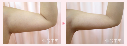 二の腕の脂肪吸引 症例写真2