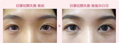 目頭切開失敗