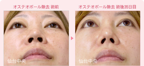オステオポール除去
