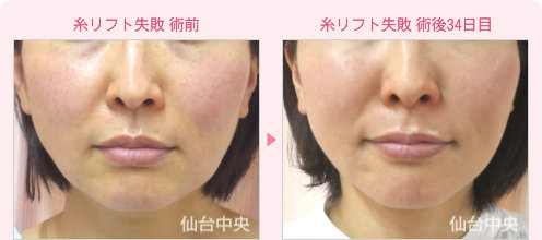 糸リフト失敗修正 症例写真1