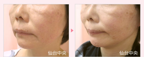 糸リフト失敗修正 症例写真3