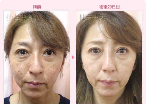 鷲鼻削りと鼻プロテーゼ 症例写真
