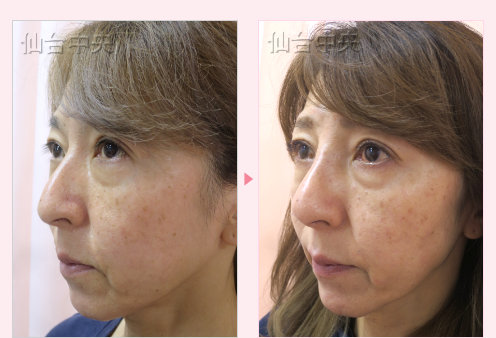 鷲鼻削りと鼻プロテーゼ 症例写真3