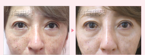 鷲鼻削りと鼻プロテーゼ 症例写真6