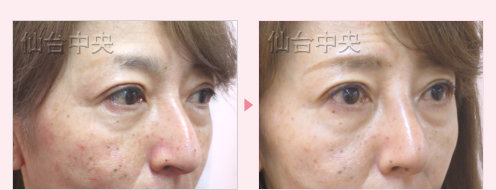 鷲鼻削りと鼻プロテーゼ 症例写真7
