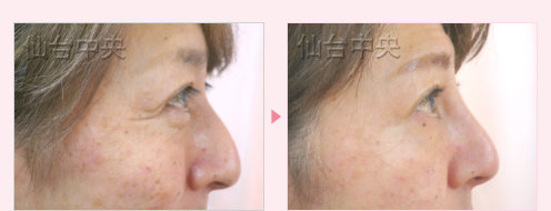 鷲鼻削りと鼻プロテーゼ 症例写真9