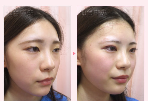 美容外科的腫れない眼瞼下垂 症例写真2