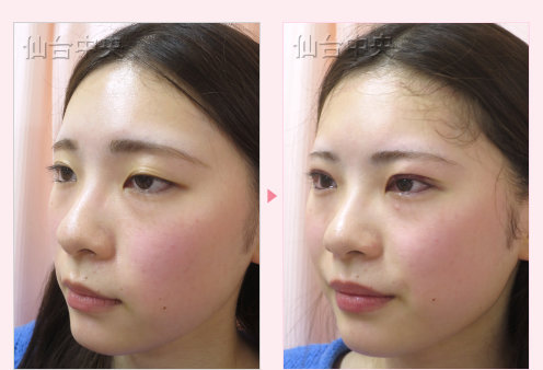 美容外科的腫れない眼瞼下垂 症例写真3