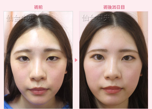 美容外科的腫れない眼瞼下垂 症例写真4