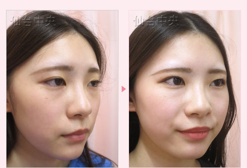 美容外科的腫れない眼瞼下垂 症例写真5