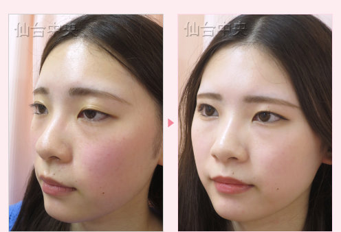美容外科的腫れない眼瞼下垂 症例写真6
