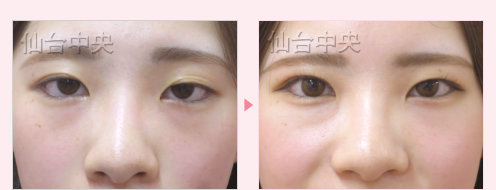 美容外科的腫れない眼瞼下垂 症例写真7