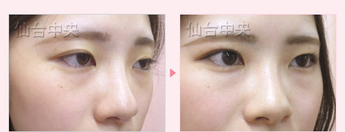美容外科的腫れない眼瞼下垂 症例写真8