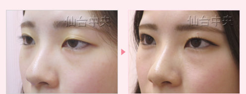 美容外科的腫れない眼瞼下垂 症例写真9