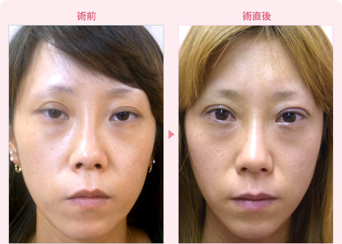 二重修正地獄の修正 症例写真1
