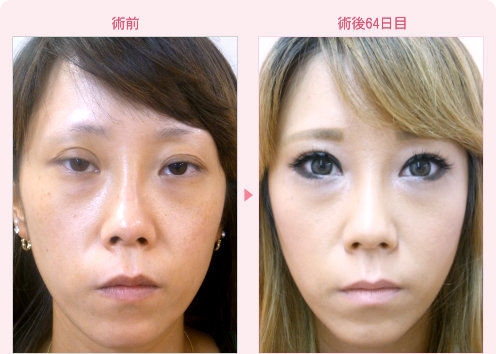 二重修正地獄の修正 症例写真3