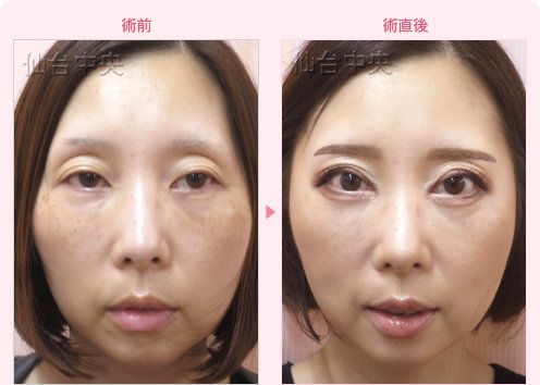 眼瞼下垂 症例写真1