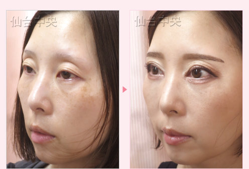 眼瞼下垂 症例写真3