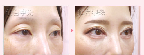 眼瞼下垂 症例写真5