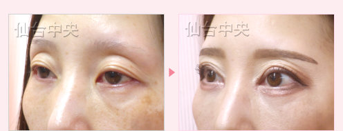 眼瞼下垂 症例写真5