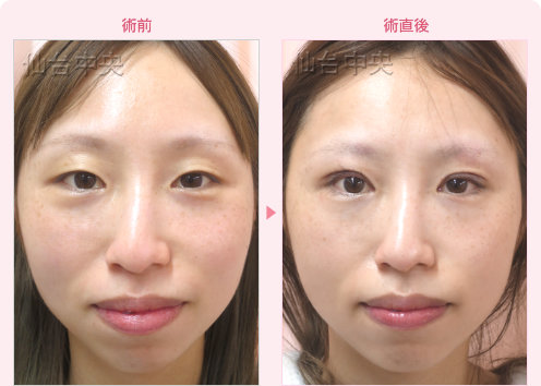 一生続く二重 症例写真1
