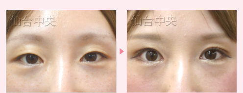 一生続く二重 症例写真10