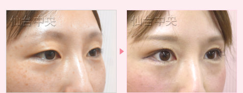 一生続く二重 症例写真11