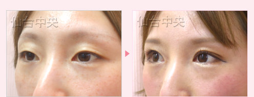 一生続く二重 症例写真12