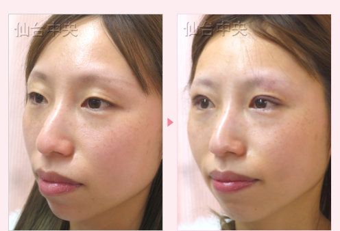 一生続く二重 症例写真3
