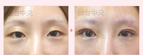 一生続く二重 症例写真4