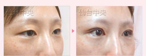 一生続く二重 症例写真5