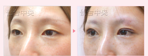 一生続く二重 症例写真6