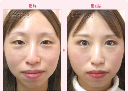 一生続く二重 症例写真7