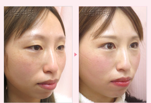 一生続く二重 症例写真8