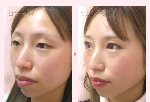 一生続く二重 症例写真9