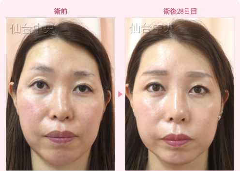目と鼻の複数個所の美容整形 症例写真1