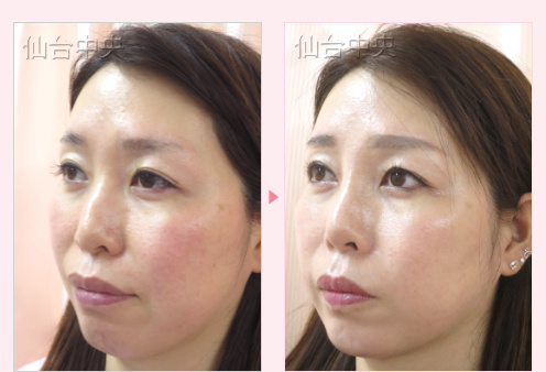 目と鼻の複数個所の美容整形 症例写真3