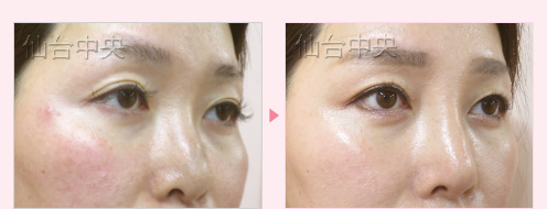 目と鼻の複数個所の美容整形 症例写真5