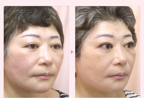 埋没法を繰り返したが希望の目にならなかった 症例写真2
