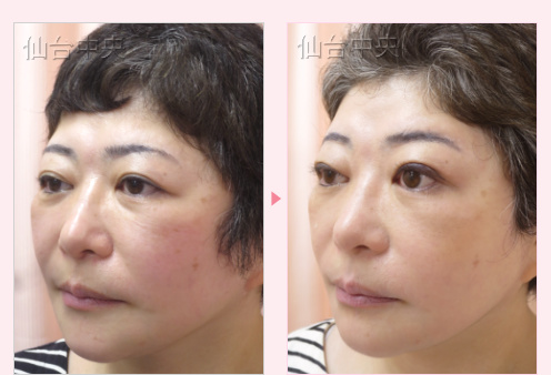 埋没法を繰り返したが希望の目にならなかった 症例写真3